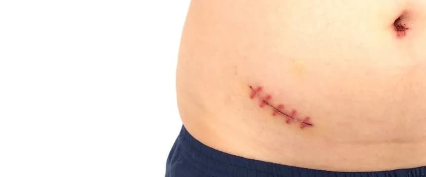 Jak długo trwa operacja wyrostka robaczkowego? Odpowiedź