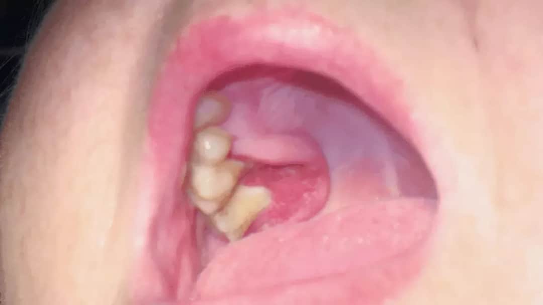 Jak wygląda rak jamy ustnej: Jak rozpoznać raka jamy ustnej na podstawie wyglądu?