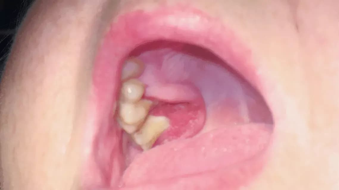 Jak wygląda rak jamy ustnej: Jak rozpoznać raka jamy ustnej na podstawie wyglądu?