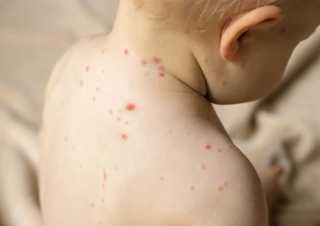 Covid wysypka u dzieci: Jak rozpoznać i leczyć wysypkę?