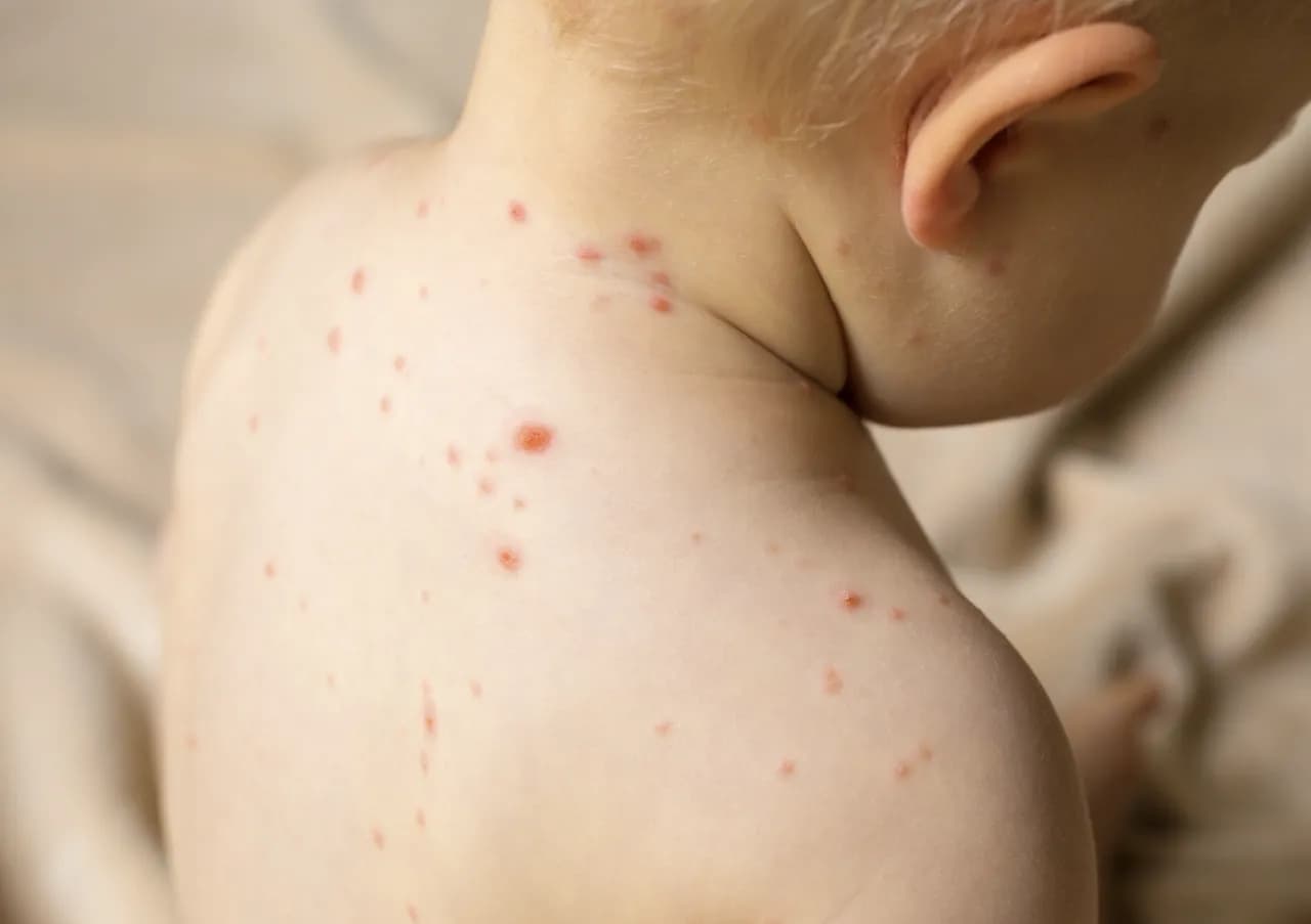 Covid wysypka u dzieci: Jak rozpoznać i leczyć wysypkę?