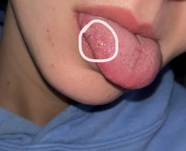 Czarna kropka na języku: Co oznacza czarna kropka na języku?